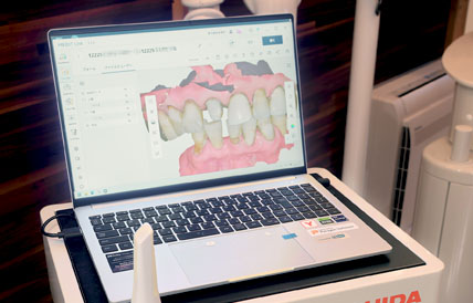 口腔内スキャナー IOS(Intraoral Scanner)